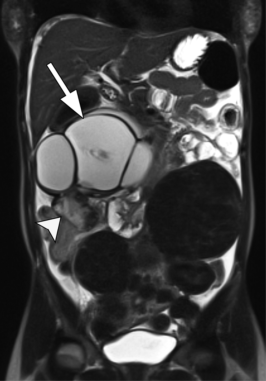Ovarian torsion secondary to serous cystadenoma